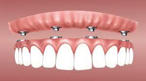 imagenes Implantes en Villa Allende